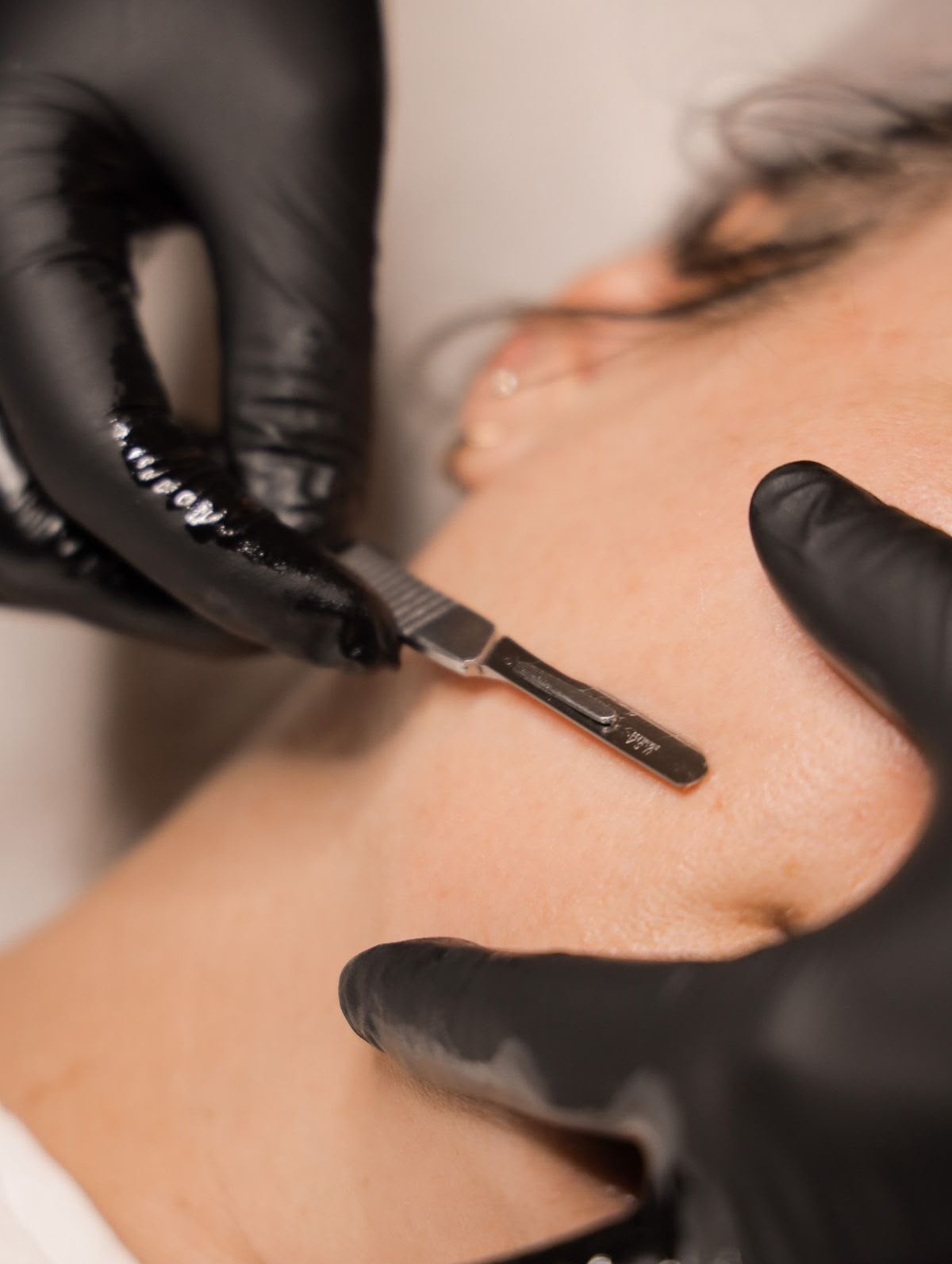 Procedimento de dermaplaning sendo realizado na Clinvittà